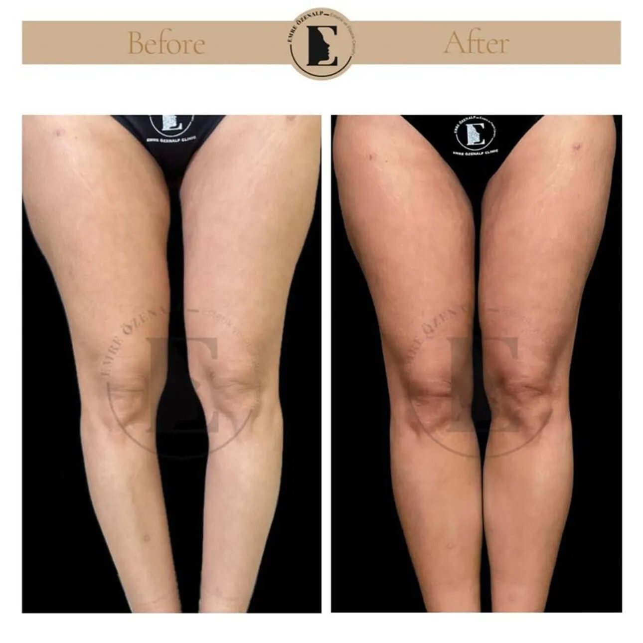Baldir (calf) implant ile çarpık bacak estetiği öncesi ve sonrası sonuçları