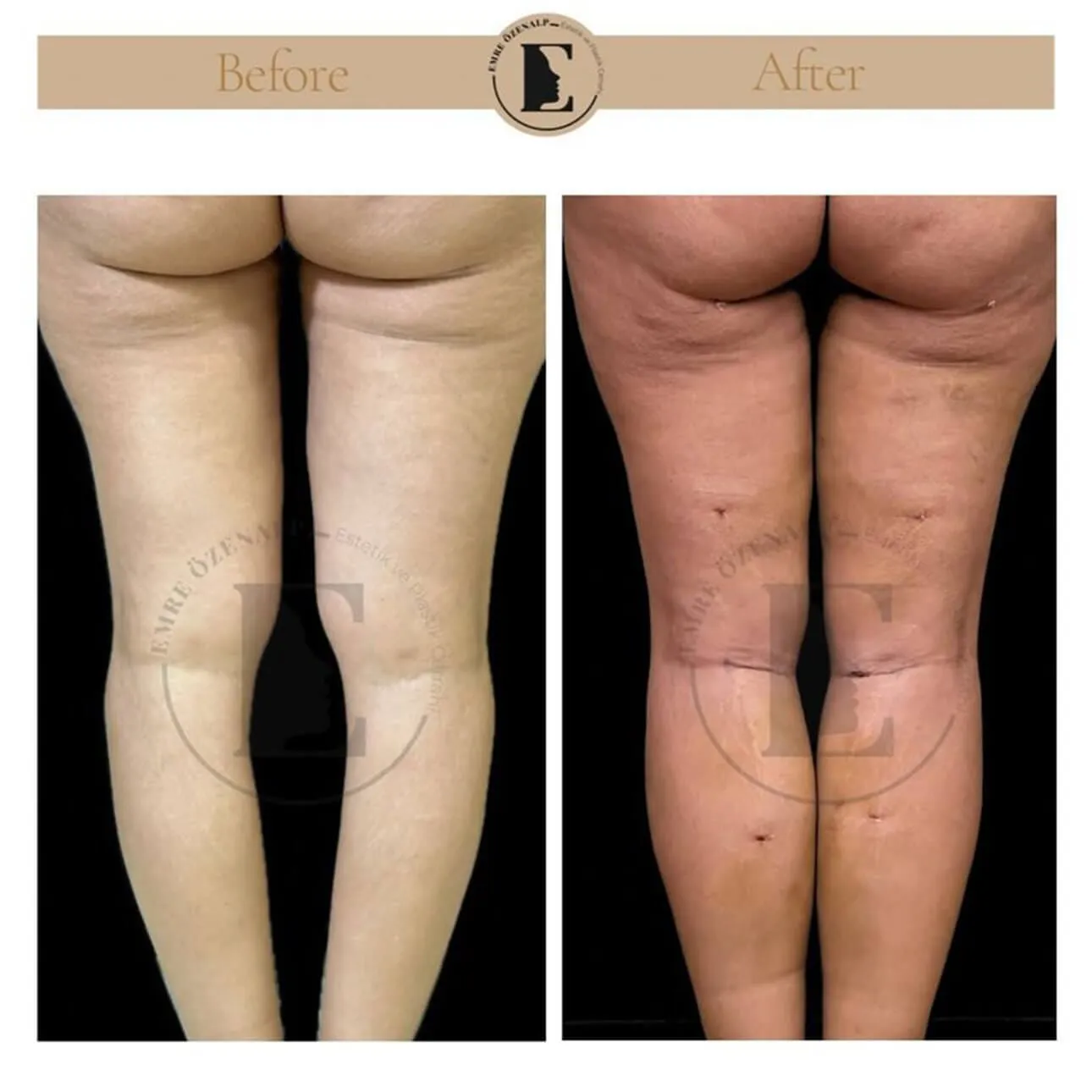 Baldir (calf) implant ile çarpık bacak estetiği öncesi ve sonrası sonuçları