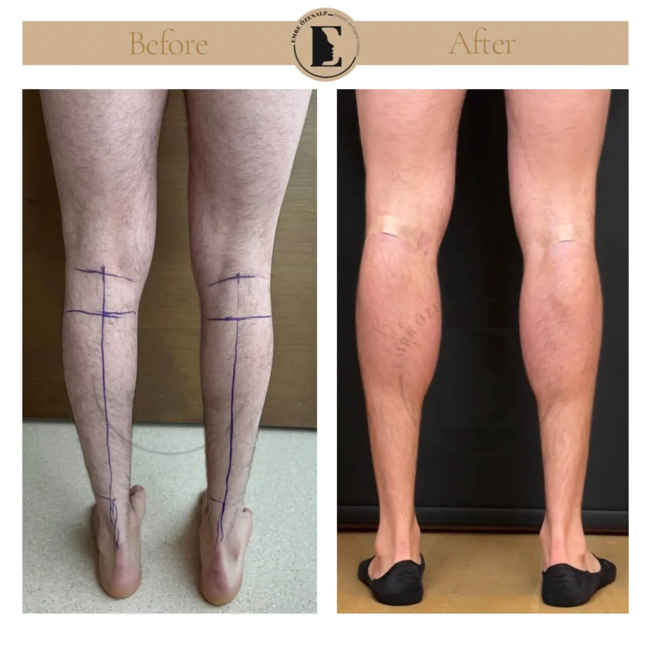 Baldir (calf) implant ile kaslı bacak görünümü estetiği öncesi ve sonrası sonuçları