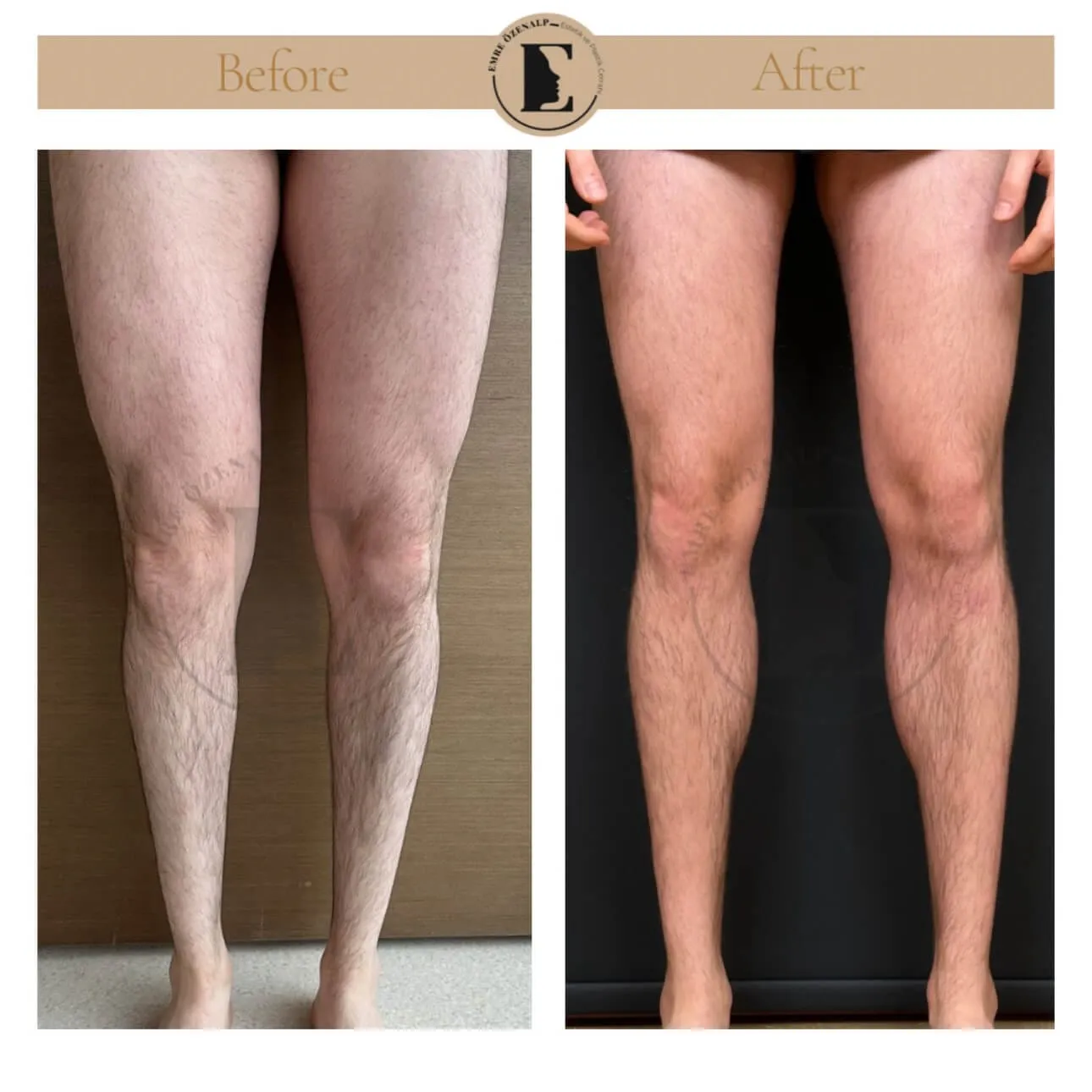 Baldir (calf) implant ile kaslı bacak görünümü estetiği öncesi ve sonrası sonuçları