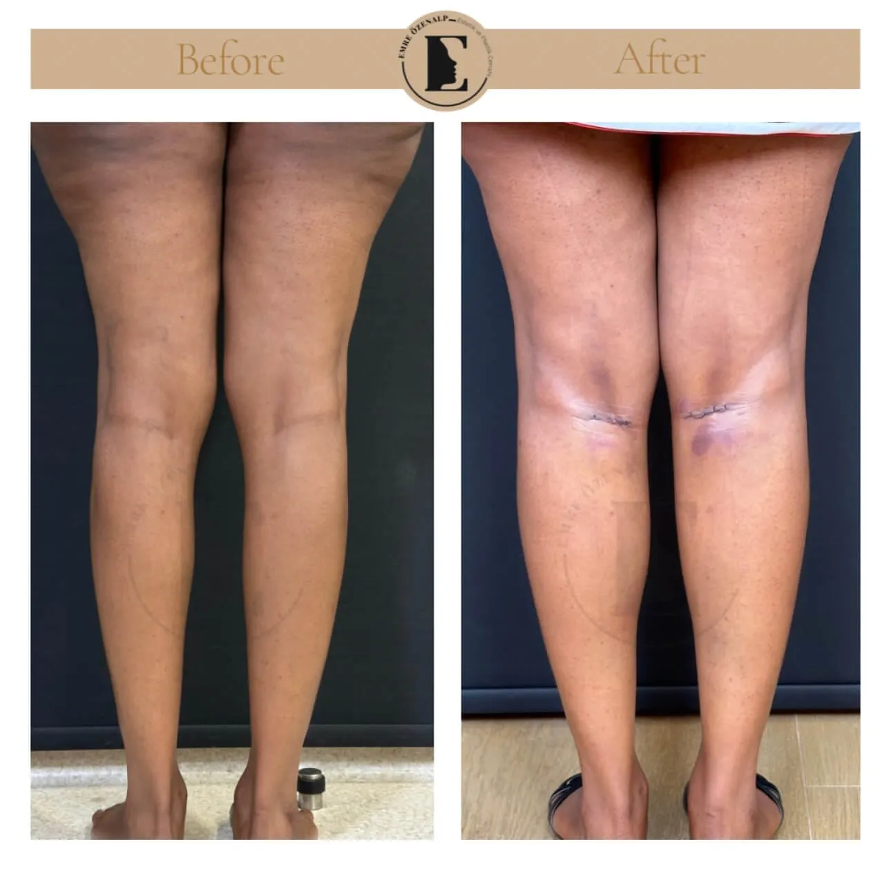 Baldir (calf) implant ile çarpık bacak estetiği öncesi ve sonrası sonuçları