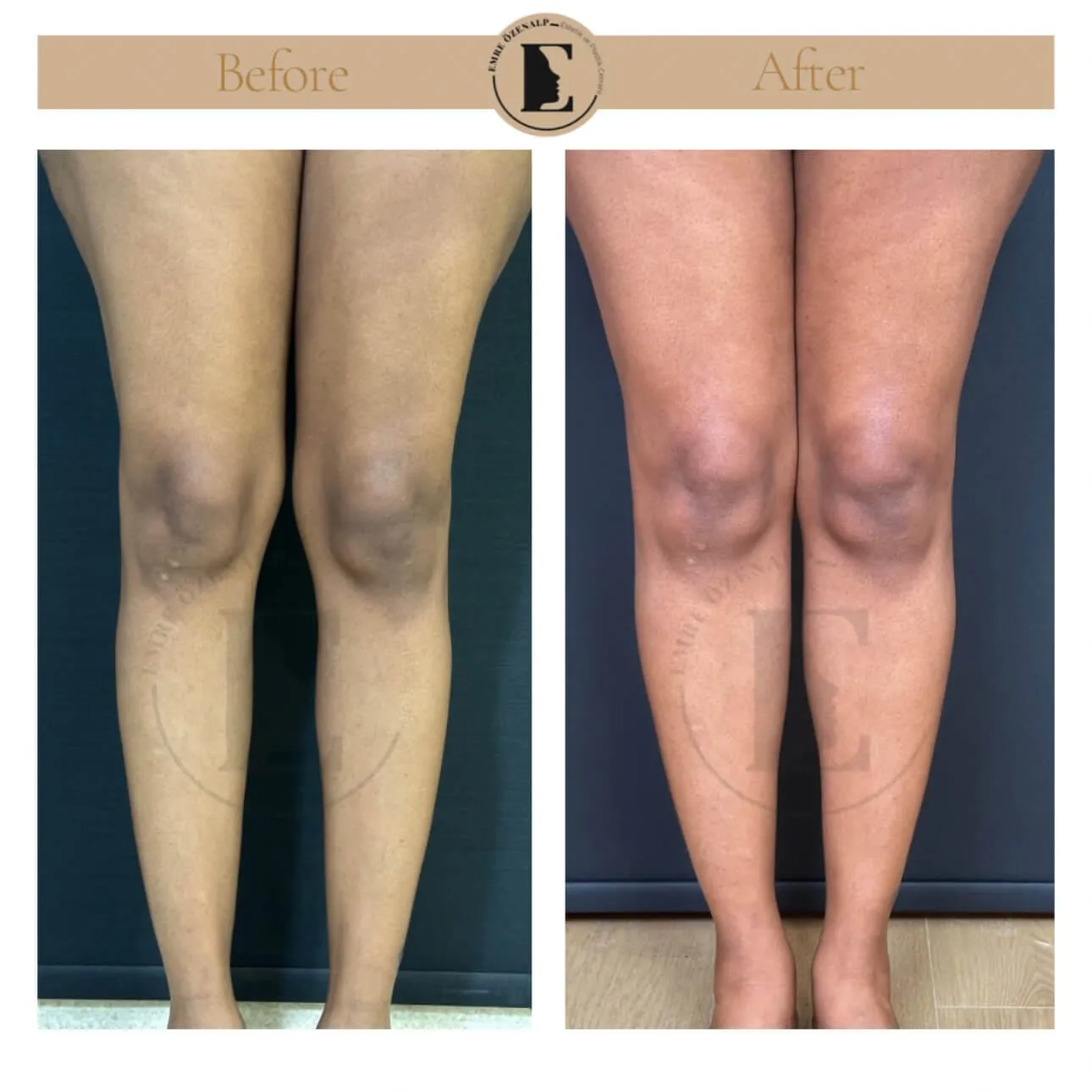 Baldir (calf) implant ile çarpık bacak estetiği öncesi ve sonrası sonuçları